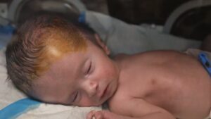 gaza’s-unseen-casualties:-a-surge-in-stillbirths-and-birth-defects